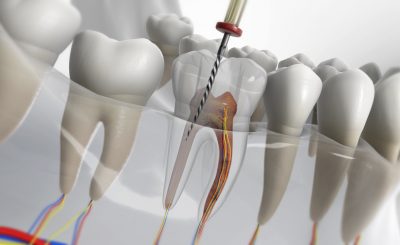 Endodontic Treatment | Tower House Dental Clinic