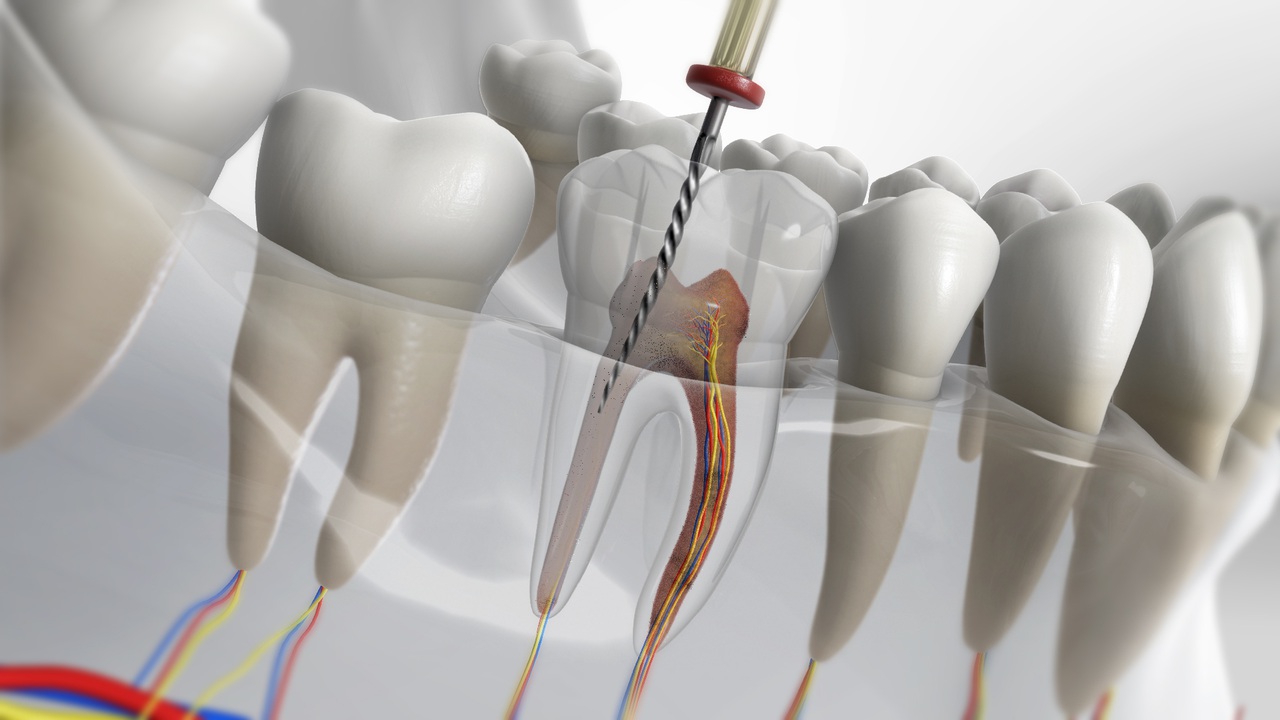 Endodontic Treatment | Tower House Dental Clinic